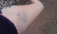 my arm after blood took